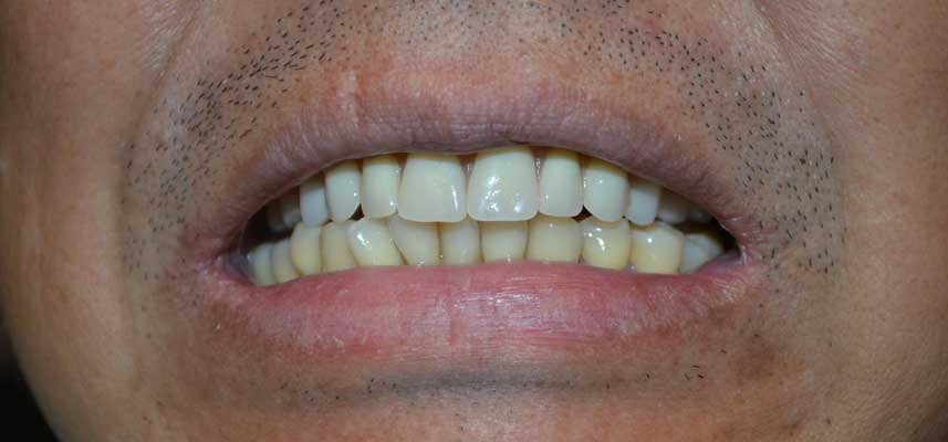 After picture of full upper denture