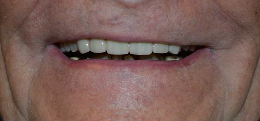 After picture of dental crowns and bridges