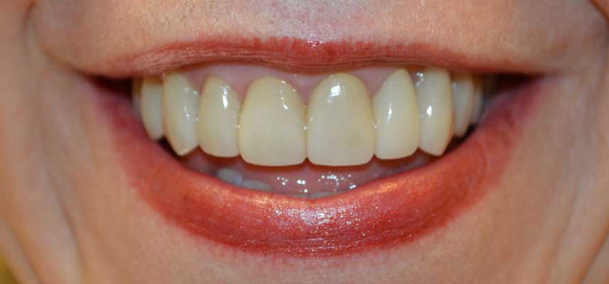 After picture of Veneers