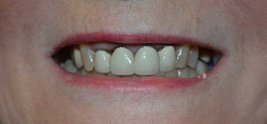 Before Picture of Dental Crown Replacements